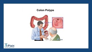 Colon Polyps [upl. by Annabal]