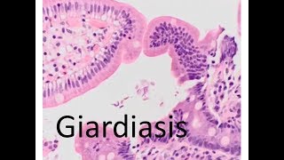 Giardiasis [upl. by Nicolette]