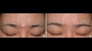 How To Get Rid Of A Sebaceous Cyst  Organic Method [upl. by Skipp504]