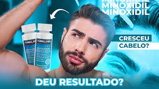 3 meses USANDO o MINOXIDIL  EXPERIÊNCIA REAL [upl. by Edd]