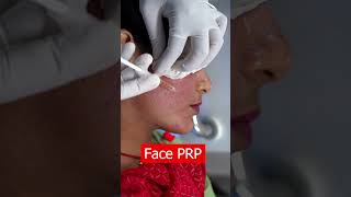 PRP Treatment for face shortsvideo [upl. by Noitsirhc269]