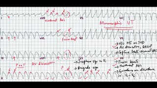 ECG quiz 4 Ventricular tachycardia or SVT with aberrancy [upl. by Ceciley824]