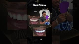 PerfectSmile PorcelainVeneers FlawlessTeeth MIAMI dentaldesign dental [upl. by Anele]