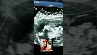 Amniotic band syndrome with Ectopia cordis fetal ultrasound by DrHaissam Aref DMS MScUltrasound [upl. by Ycniuqal885]