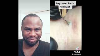 Ingrown hair removal video reaction [upl. by Luigino]