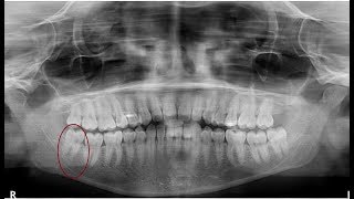 Pericoronitis wisdom tooth extraction [upl. by Perron]