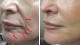 Just 2 skin tightening and face lifting home remedies [upl. by Xavler]