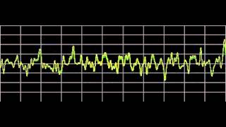 Cluster Headaches  Rife Frequencies [upl. by Meuse]