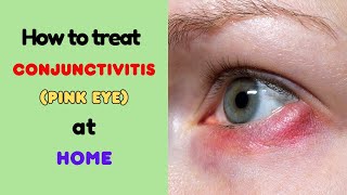 Conjunctivitis pink eye home remedies natural remedies home treatment natural treatment [upl. by Alemaj]