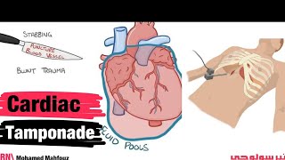 Cardiac Tamponade  Pericardiocentesisi [upl. by Noletta]