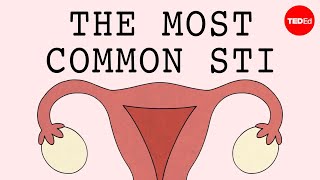 The most common STI in the world  Emma Bryce [upl. by Aisnetroh430]