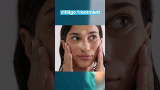 Vitiligo Treatment by Surgery  Dr Gaurav Garg Dermatologist [upl. by Weiman763]