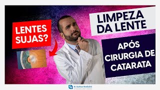 Capsulotomia com YAG laser limpeza da lente após cirurgia de catarata  Dr Gustavo Bonfadini [upl. by Nosidda]