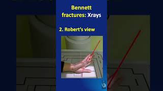 Shorts  106 Bennet fracture dislocation  Xrays to be taken  and how to take them [upl. by Galatia]