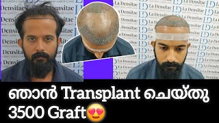 My Hair Transplant At La Densitae Hair Transplant Clinic [upl. by Atnauqahs]