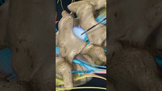 Lumbar Epidural Steroid Injection 3D Animation [upl. by Bohlin]