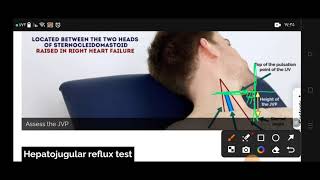 jugular venous pressure osce inspect neck veins [upl. by Suk]