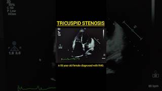 Tricuspid Stenosispulmonary pulmonaryarterialhypertension pulmonaryembolismaortaheartfailure [upl. by Yliram]