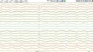 EEG Ictalinterictal continuum [upl. by Yenffit452]