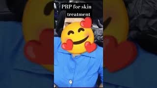 PRP for skin treatment asthetic [upl. by Aihtnys]