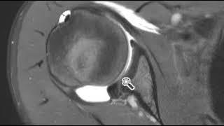 Hypoplastic posterior glenoid [upl. by Claudelle]