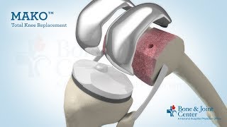 Full Knee Replacement  Mako Robotic Arm Assisted Surgery Technology [upl. by Fortier]