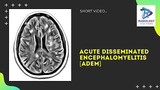 Acute disseminated encephalomyelitis MRI  ADEM Umamaheswara ReddyV [upl. by Thecla]