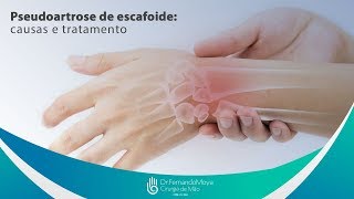 Pseudoartrose de escafoide causas e tratamento  Dr Fernando Moya CRM 112046 [upl. by Nnahtebazile89]