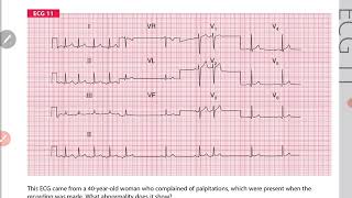 Atrial tachycardia and atrial extrasystole [upl. by Nylasoj]