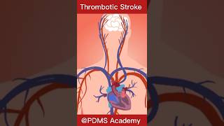 Stroke  Ischemic stroke pathology disease [upl. by Anyal]