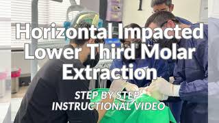 Horizontal Impacted Lower Third Molar Extraction Step by Step Instructional Video 103 [upl. by Nykal119]