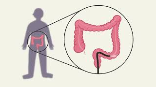 Colorectal cancer screening Arabic [upl. by Lynnworth147]