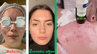 Clear skin laser treatment for ACNE  2022 bespoke acne innovation treatment that actually works [upl. by Irene]