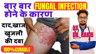 DAD KI SAHI ILAJRING WORM TREATMENTखाज खुजली की दवाFUNGAL INFECTION TREATMENTTINEADRRAKIB [upl. by Ais]