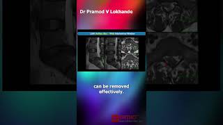 Importance of Interlaminar Space  Dr Pramod Lokhande [upl. by Atnohsal115]