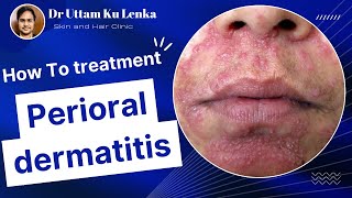 Perioral dermatitisAcne amp Rosacea Red rashes around mouth face me rashes ka karan druttam [upl. by Tonneson]