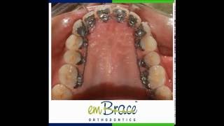 InvisibleHidden Braces Embrace Orthodontics [upl. by Morita]