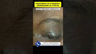 Treatment of pyogenic granuloma  By Dr Uttam Kumar Lenka MBBS MD Consultant Dermatologist [upl. by Atinele]