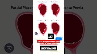 Placenta previacausesignpositionimportant topics video viral placentia [upl. by Telracs]