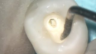 Premolar access cavity preparation [upl. by Kellyann215]