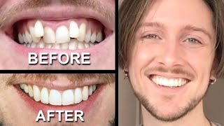 INVISALIGN REVIEW  everything you need to know [upl. by Neelahtak88]