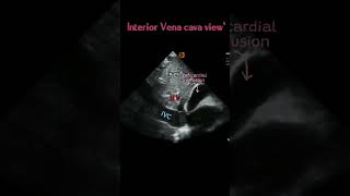 Inferior Vena cava View  short video ⚕️ [upl. by Netsirt]