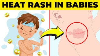 Heat Rash in Babies Explained Causes Symptoms amp Effective Home Remedies [upl. by Alvan]