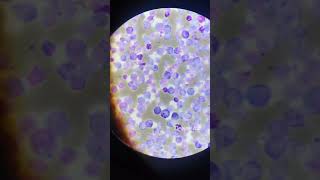 Marrow cells present CML microscope reels medicallabviralvideo [upl. by Nadruoj]