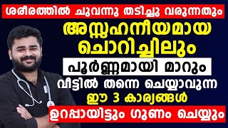 ചുവന്ന്തടിച്ചു വരുന്നതും അസഹനീയമായ ചൊറിച്ചിലും മാറാൻ ഇങ്ങനെ ചെയ്‌താൽ മതി skin allergy malayalam [upl. by Kylynn]