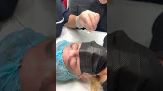 Microblading Removal with Magnetic Tattoo Removal Technique [upl. by Octavie905]