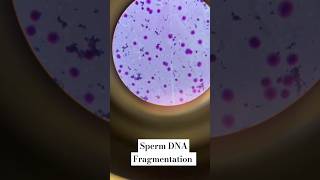 Sperm DNA 🧬 Fragmentation DFI Slide sperm spermhealth [upl. by Komarek91]