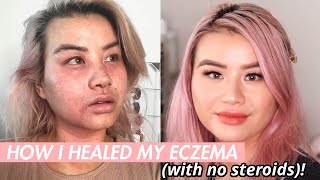 HOW I NATURALLY HEALED MY ECZEMA IN 3 STEPS with no topical steroids [upl. by Aneloj194]