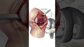 Learning about Osteoarthritis with Dr Shekhar Srivastav [upl. by Eckmann]