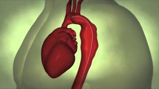 Thoracic Aortic Aneurysm [upl. by Joshuah]